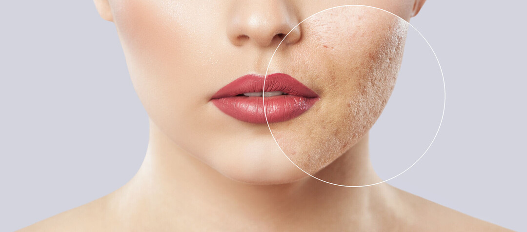 Warum bekommt man durch Make-up Pickel?
